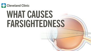 What Causes Farsightedness [upl. by Robinetta]