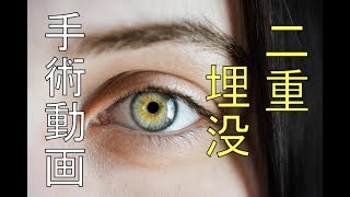 【埋没法】二重手術【閲覧注意】【手術動画】仙台 美容整形Double Eyelid Surgery [upl. by Icam653]