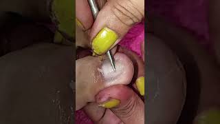 Cleaning thick toenail deep ingrown pedicure satisfying shortvideo [upl. by Merrel952]