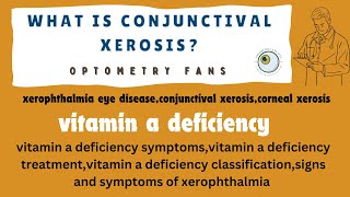 vitamin a deficiency  xerophthalmia eye disease  conjunctival xerosis  corneal xerosis [upl. by Cayser477]