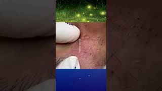 Blackheads Removal  Acne Treatment and Very Satisfying Satisfying Pimple pop blackheads [upl. by Assilav228]