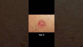 Basal Cell Carcinoma Skin Cancer Development Time Lapse Normal to Cancer Over 25 Years [upl. by Yeslehc160]