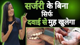 Surgery Ke Bina Sirf Davaiyo Se Muh khulega  Treatment for Oral Submucosa Fibrosis  OSMF [upl. by Eisiam198]