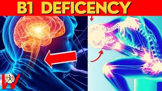 Sleep Apnea and Vitamin B1 Deficiency  😴 Sleep apnea [upl. by Siffre]