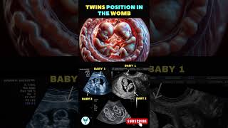 Twinning inside the belly ❤️❤️ Twins  Twin pregnancy  Twin baby bump shortsfeed pregnancy baby [upl. by Corbett]