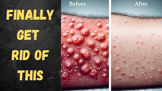 How I Got Rid of My Keratosis Pilaris on my Arms [upl. by Einiffit]