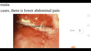Trichomoniasis [upl. by Beauchamp]