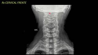 Radiología de la columna vertebral [upl. by Aisela755]