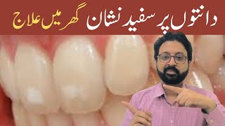 How to Remove White Spots on Teeth Home Remedies [upl. by Toombs]