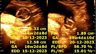 16 weeks 2 days pregnancy  Normal pregnancy [upl. by Asirret]