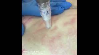 Skinpen Microneedling Procedure To Treat Stretch Marks [upl. by Nayarb872]