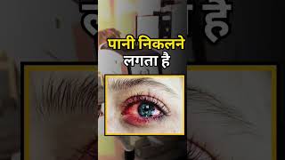 😱 मचाया आई फ्लू ने तहलका 😰EYE FLU 👁️EYES PROBLEM👀 CONJUNCTIVE Symptom💀 आँखो बिमारी के लक्षण [upl. by Ronal]