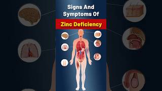 Zinc Deficiency  What Are The Critical Symptoms Of Zinc Deficiency zincdeficiency zinc [upl. by Sill]