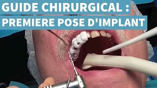 POSER SON 1ER IMPLANT EN CHIRURGIE GUIDÉE [upl. by Ariaet558]