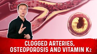 Clogged Arteries Osteoporosis and Vitamin K2 – Dr Berg [upl. by Nylyoj]