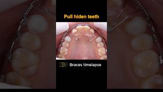 Pull x2 hiden teeth with braces braces orthodontist bracesoff dentist [upl. by Aisinoid554]