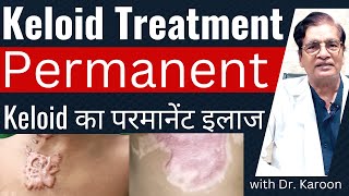 Keloid Removal Treatment  Keloid का इलाज  Dr Karoon Agrawal [upl. by Anirbac]