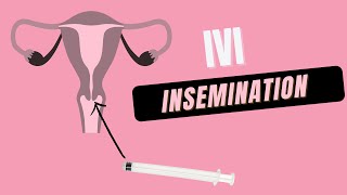 How to do at Home IVI Insemination [upl. by Eerdna]