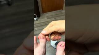 Reattachment of toenail to the nail bed with laser therapy Dr Stewart at TFAC [upl. by Hgalehs]