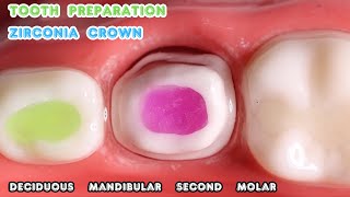 Tooth Preparation for Zirconia Crown in Primary Mandibular Molar 🔵 Precident Pedo Burs [upl. by Nodnarg]