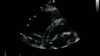 ARVC ARRHYTHMOGENIC RIGHT VENTRICULAR CARDIOMYOPATHY DAVD [upl. by Macintyre]