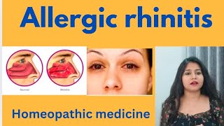 Allergic rhinitis treatment  Allergic rhinitis symptomscauses amp homeopathic medicine in hindi [upl. by Ashely]