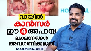 വായിൽ കാൻസർ ഈ 4 രോഗ ലക്ഷണങ്ങൾ അവഗണിക്കരുത്  Oral Cancer  Dr Santhosh Kumar [upl. by Libove]