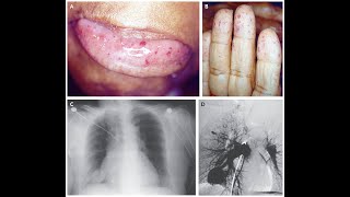 Hereditäre hämorrhagische Telangiektasie [upl. by Omura182]