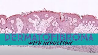 Dermatofibroma with induction phenomenon pathology dermpath dermatology dermatopathology [upl. by Warila]