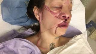 Jennifer Hiles 21717 AVM NYC surgery 11 update [upl. by Elyc]