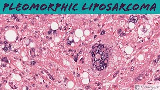 Pleomorphic Liposarcoma 5Minute Pathology Pearls [upl. by Emily269]