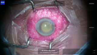 Endophthalmitis Unedited  IOL Removal  Vitrectomy  IVAB  SOI under LA [upl. by Deste382]