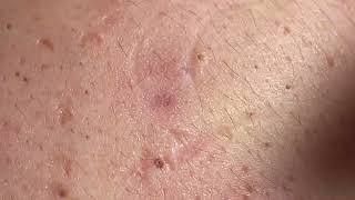 Acne Treatment Huong Da Nang  2024 blackheads 703 [upl. by Meade718]