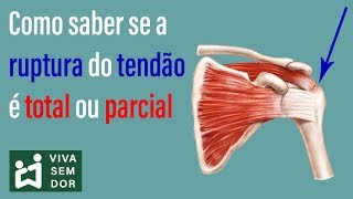 Como saber se a ruptura do tendão é total ou parcial [upl. by Nanete]