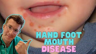 How to recognise amp treat Hand Foot and Mouth Disease Coxsackievirus in kids  Doctor ODonovan [upl. by Morgen]