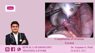 Ovarian Torsion by Dr Gajanan Patil  Kewal Hospital  Laparoscopy Training [upl. by Pich]