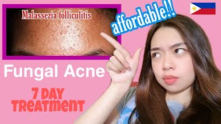 FUNGAL ACNE 1 WEEK TREATMENT  tiny little bumps MALASSEZIA FOLLICULITIS [upl. by Ilzel]