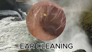 Severely Retracted Eardrum Ear Wax Removal  EAR CLEANING [upl. by Aires]