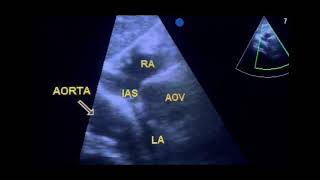 Thoracic aorta mimicking a cyst to drahmadmirdamadisiLWTYGsHPjR19laMW [upl. by Tamah17]