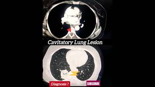 Cavitatory lung lesion  HRCT Chest  Diagnosis [upl. by Aralk]