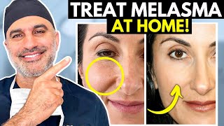 What you NEED to know about treating Melasma AT HOME the RIGHT way [upl. by Christin]