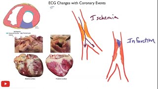 Myocardial ischemia amp infarction  STEMI NSTEMI Q wave infarction Wellens syndrome [upl. by Eiramassenav]