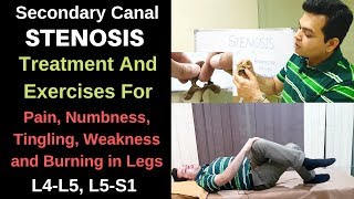 Spinal stenosis L4L5L5S1 Foraminal stenosis Spinal Stenosis treatment spine stenosis exercises [upl. by Tyrone]