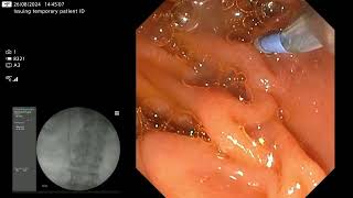 Trapezoid lithotripsy  how I do it [upl. by Ainnos]