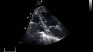 CHRONIC PERICARDITIS with thickening of the pericardium [upl. by Arama]