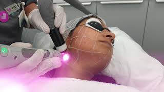 Performing Laser hair removal treatment on face [upl. by Meaghan201]