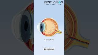 Keratoconus Treatment amp Screen Time Tips for Healthy Eyes  bestvisioneyehospital999 eyecare [upl. by Erl]