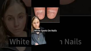 White Spots On Nails Explained dermatologist [upl. by Niel]