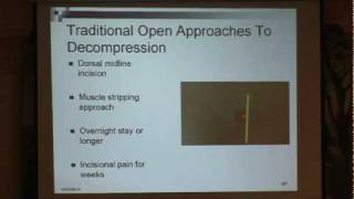 Lumbar Spinal Stenosis Part 3 Neurosurgical Treatment Options Paul Houle MD [upl. by Elkraps]