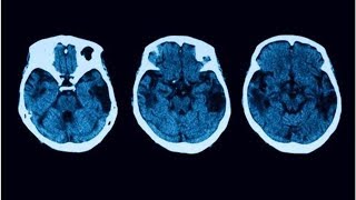 Atrofia cortical posterior diagnóstico y tratamiento  Maha TV [upl. by Prisca]